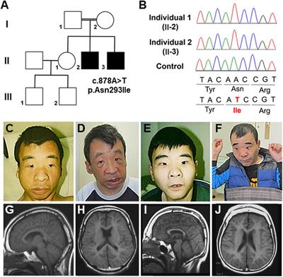 OTUD5 Variants Associated With X-Linked Intellectual Disability and Congenital Malformation